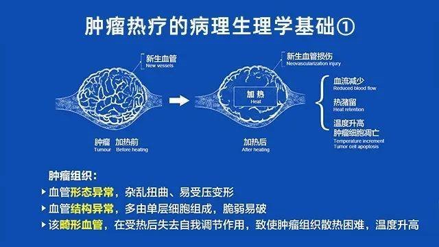 肿瘤热疗是什么？——“热死”肿瘤！