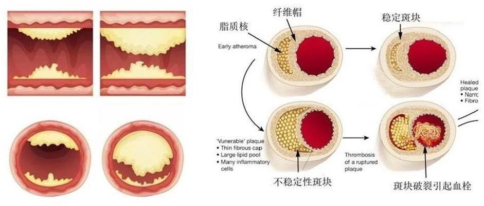 发现颈动脉斑块怎么办？