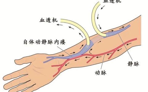 守护“生命线”——透析动静脉内瘘的超声评估