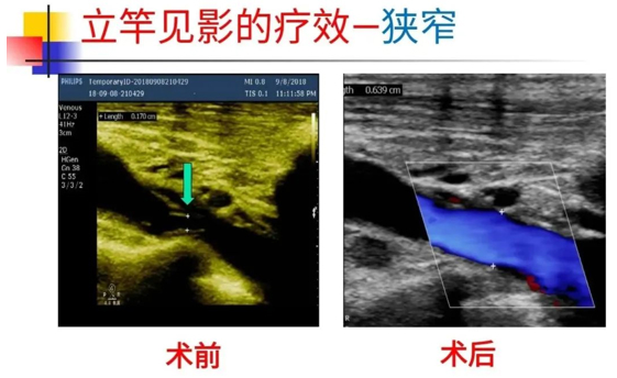 守护“生命线”——透析动静脉内瘘的超声评估