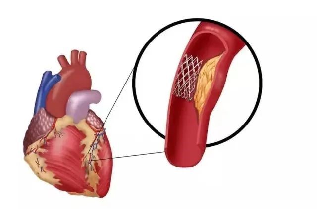心脏介入术后不可忽视定期复查