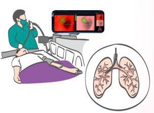 一文读懂呼吸内镜,呼吸健康的“守护者”