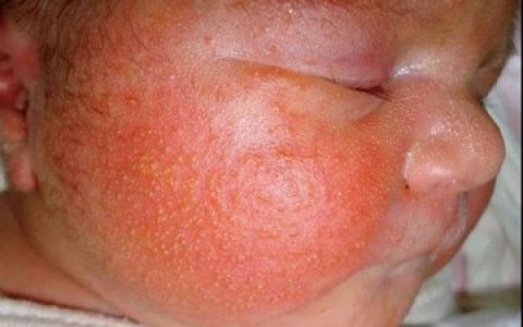 婴幼儿湿疹，不一定是过敏引起的