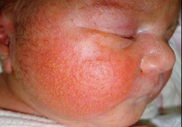 婴幼儿湿疹，不一定是过敏引起的