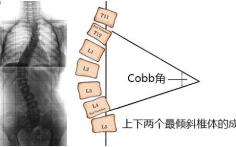 关注青少年脊柱健康 “脊”不可失