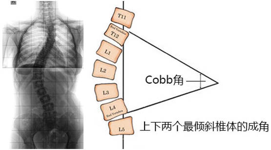 关注青少年脊柱健康 “脊”不可失