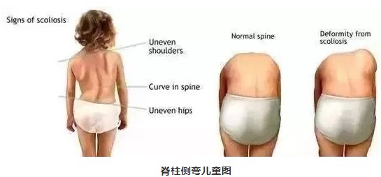 关注青少年脊柱健康 “脊”不可失