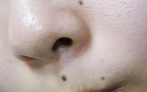 小小年纪，为啥也长痣？