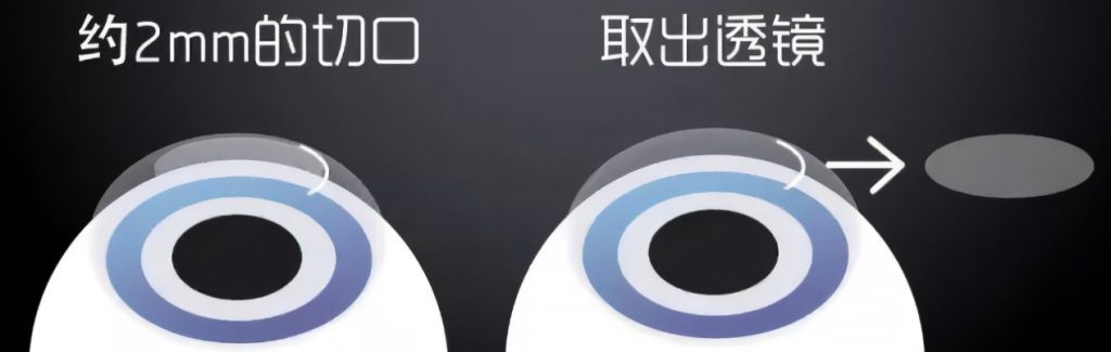 全飞秒术前准备知多少