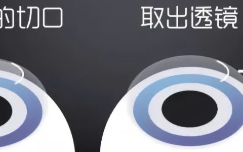全飞秒术前准备知多少