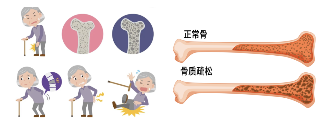 “静悄悄”的健康大问题 —— 骨质疏松