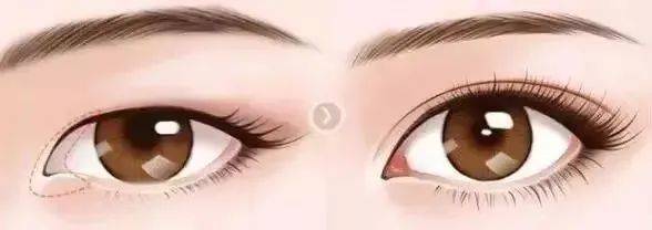 眼皮问题，你想知道的都在这儿