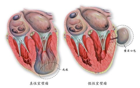 心血管此瘤非彼瘤之一——心脏室壁瘤
