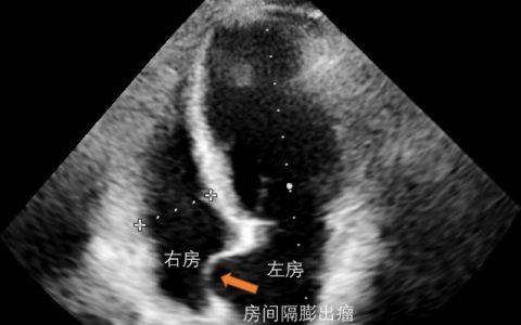 心血管此瘤非彼瘤之二——房间隔膨出瘤