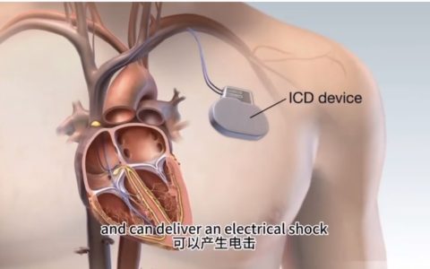 守护心跳的“隐形卫士”——ICD（植入式心律转复除颤器）