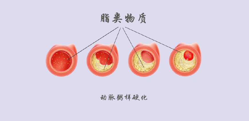 关于“血脂”的深度探讨——医患对话