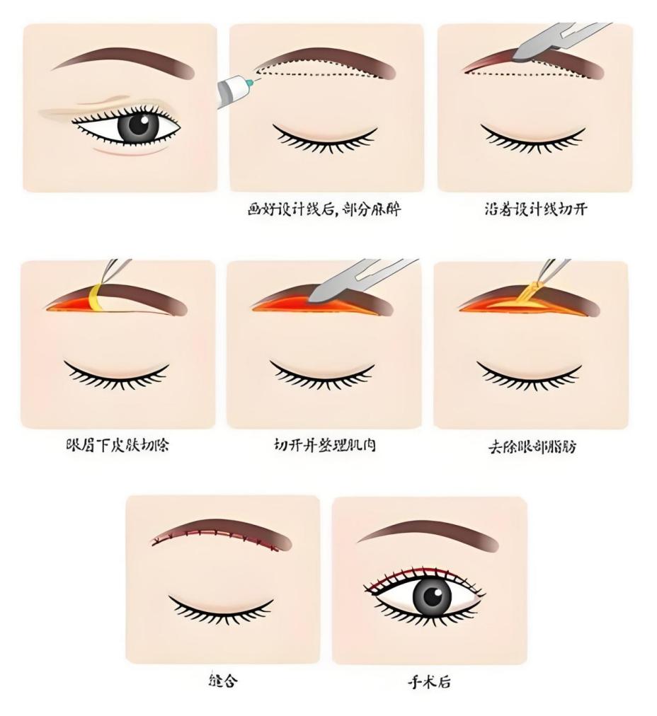 40岁，切眉还是双眼皮？这篇给你答案：抗衰不是“二选一”，是“找回自己”