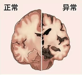 阿尔茨海默症——残酷的“大脑退化之旅”