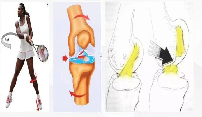 且行且珍膝-前交叉韧带重建术后的康复治疗