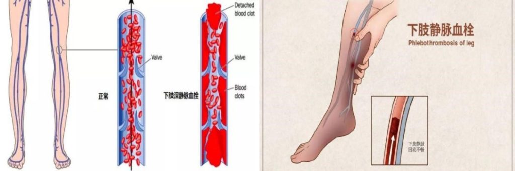 肌间静脉血栓:一位76岁患者的气喘之谜与身体里的“潜伏者”