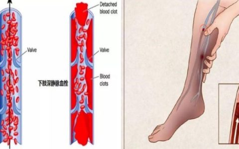 肌间静脉血栓：一位76岁患者的气喘之谜与身体里的“潜伏者”