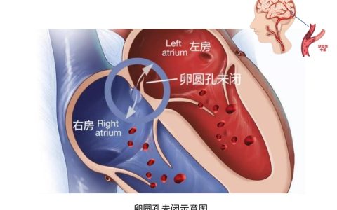 小心眼，大问题——卵圆孔未闭如何治疗