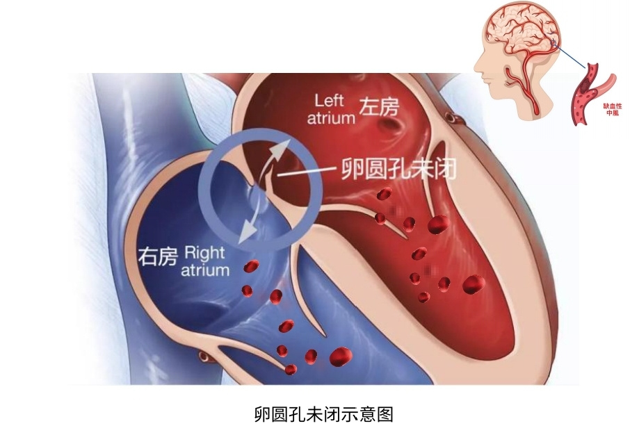 小心眼，大问题——卵圆孔未闭如何治疗