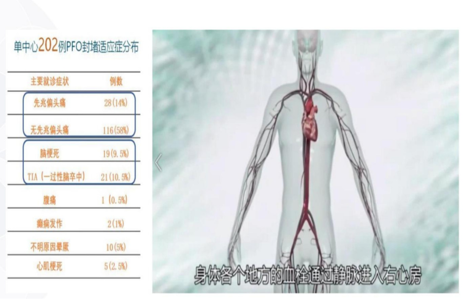小心眼，大问题——卵圆孔未闭如何治疗