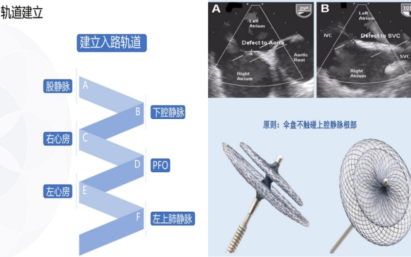 小心眼，大问题——卵圆孔未闭如何治疗