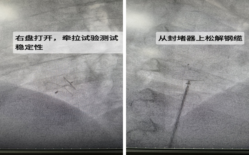 小心眼，大问题——卵圆孔未闭如何治疗