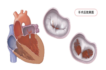 心“门”关不严?微创“夹子”来帮忙!——认识武汉市领航技术:TEER手术