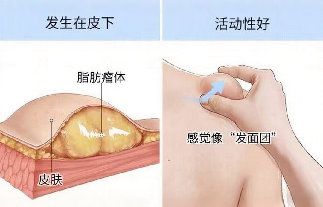 体表肿瘤:了解你皮肤上的“小疙瘩”