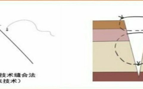 外伤美容缝合：最小化瘢痕，最大化美观