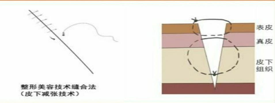 外伤美容缝合：最小化瘢痕，最大化美观