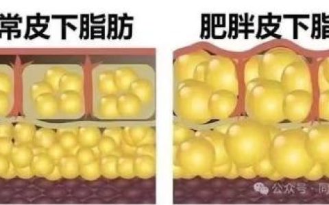 告别“顽固”脂肪？吸脂术全解析——关于吸脂，你想知道的在这里