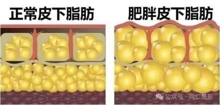 告别“顽固”脂肪?吸脂术全解析——关于吸脂,你想知道的在这里