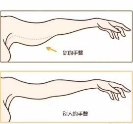 告别“顽固”脂肪?吸脂术全解析——关于吸脂,你想知道的在这里