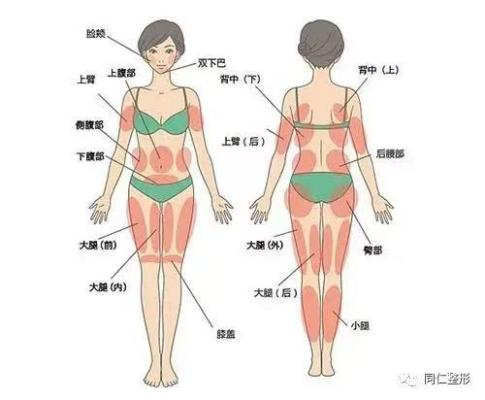 告别“顽固”脂肪?吸脂术全解析——关于吸脂,你想知道的在这里