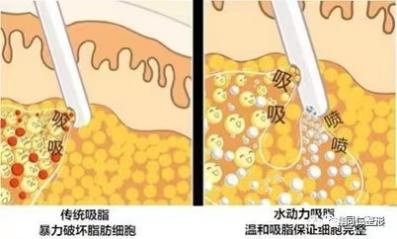 告别“顽固”脂肪?吸脂术全解析——关于吸脂,你想知道的在这里