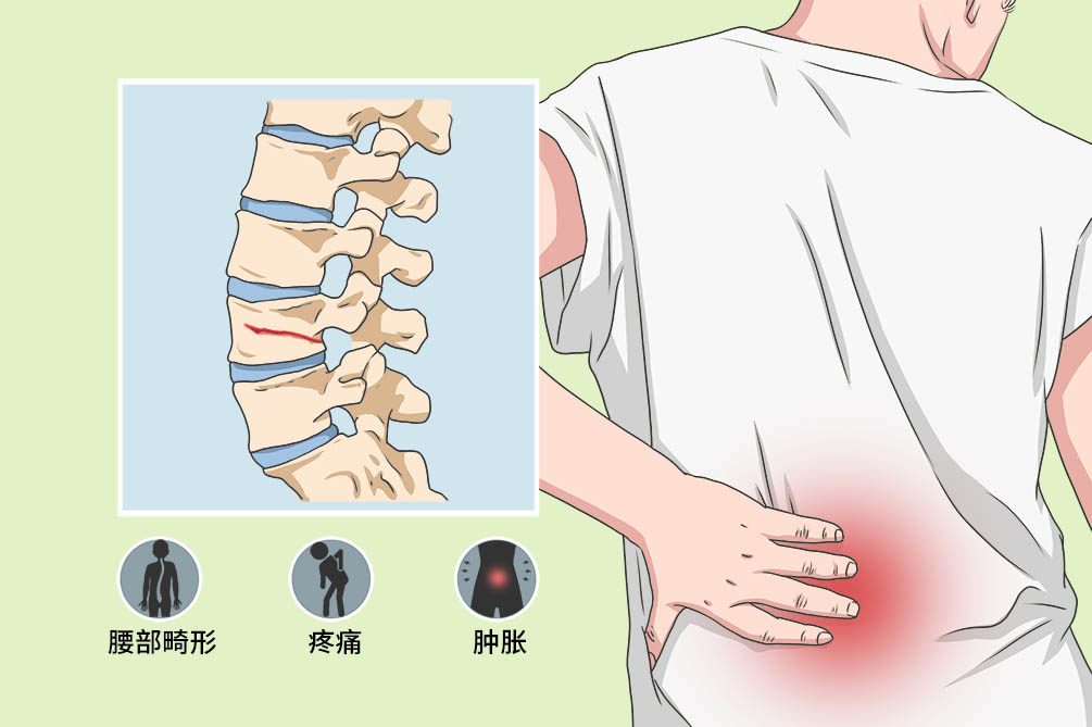 “脆皮”年轻人,如何拯救你的“玻璃腰”