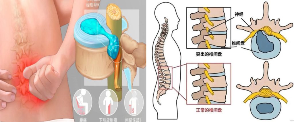 “脆皮”年轻人,如何拯救你的“玻璃腰”